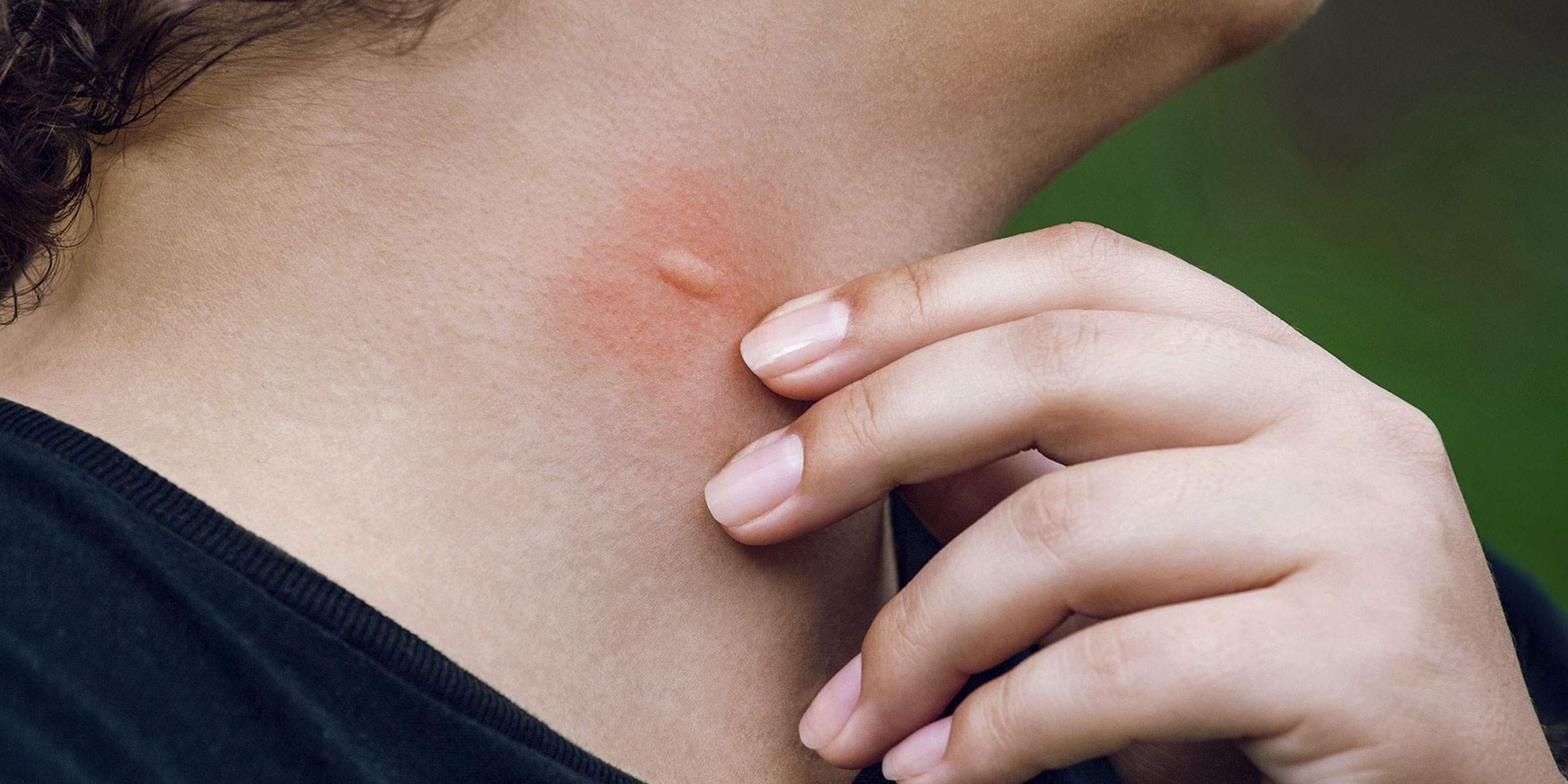 Relieve itching after an insect bite